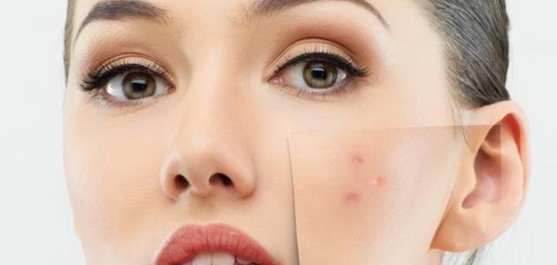 Efectos de las espinillas en la cara y tratamiento.