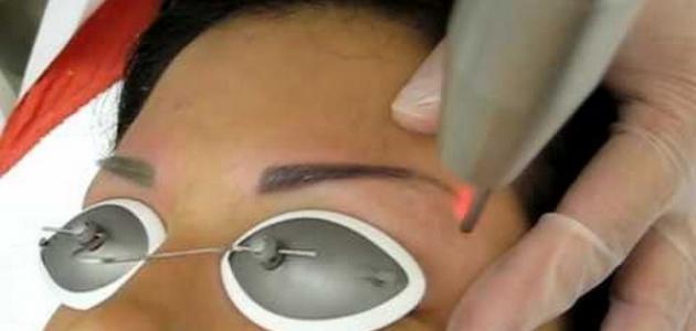 Laser eyebrow tattoo removal