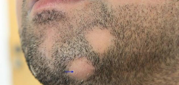 Chin alopecia treatment