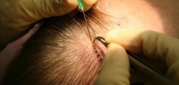 How is hair transplantation done?