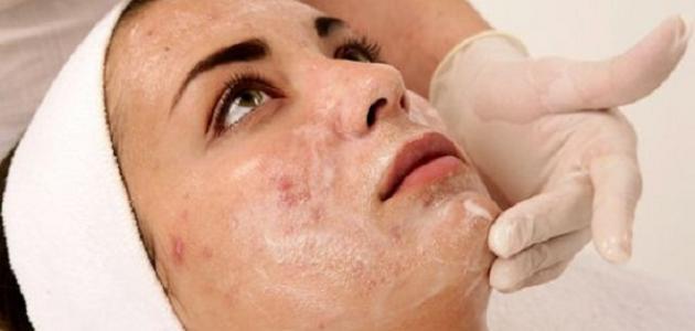 When does acne disappear?
