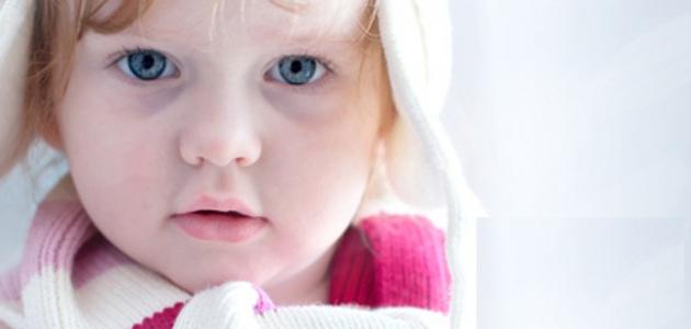 Ursachen der Schwärzung unter den Augen bei Kindern