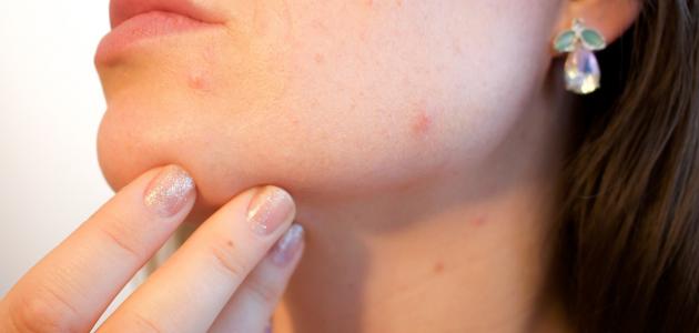 The fastest way to hide facial pimples