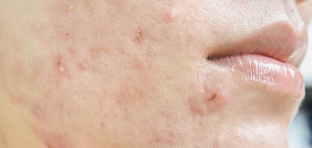 Types de cicatrices d'acné