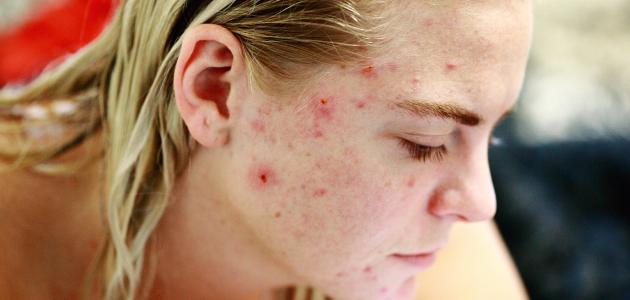 Inflamed acne