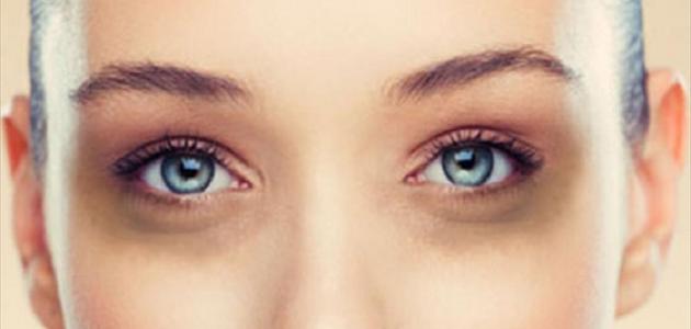 The cause of dark circles under the eyes and their treatment