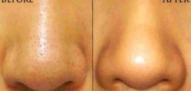How to get rid of blackheads in the nose