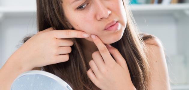 The appearance of pimples on the face during menstruation