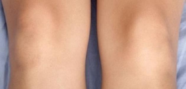 How to get rid of dark knees