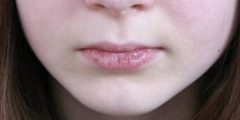 Causes of chapped lips in children