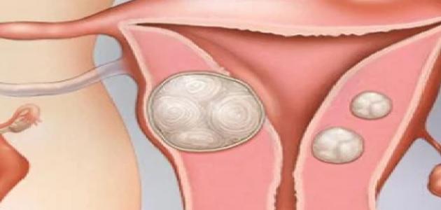 Tratamiento de los fibromas uterinos.
