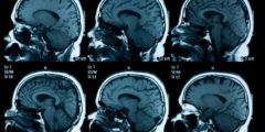 Treatment of simple cerebral atrophy in children