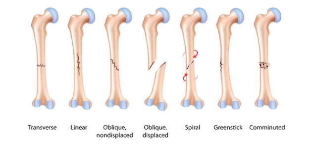 Orthopedic signs