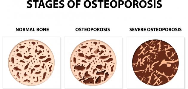 Was sind die Symptome einer Osteoporose?