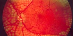 Symptoms of diabetic retinopathy