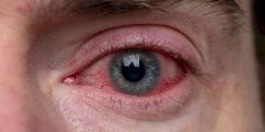 What is the cause of eye redness?