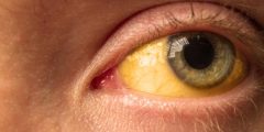 علاج صفار العين